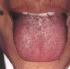 Significado de lengua grasosa. MTC
